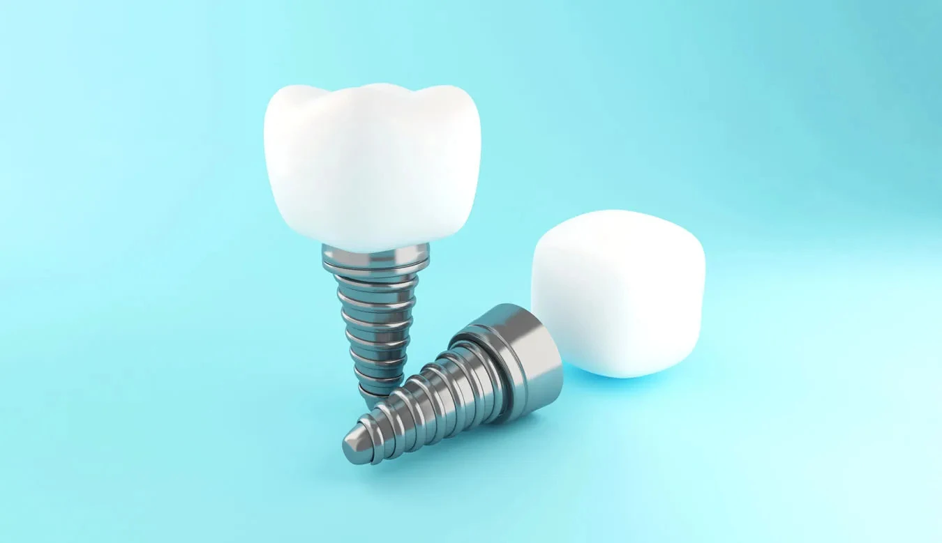Affordable Dental Implants in Cudahy for a Confident Smile