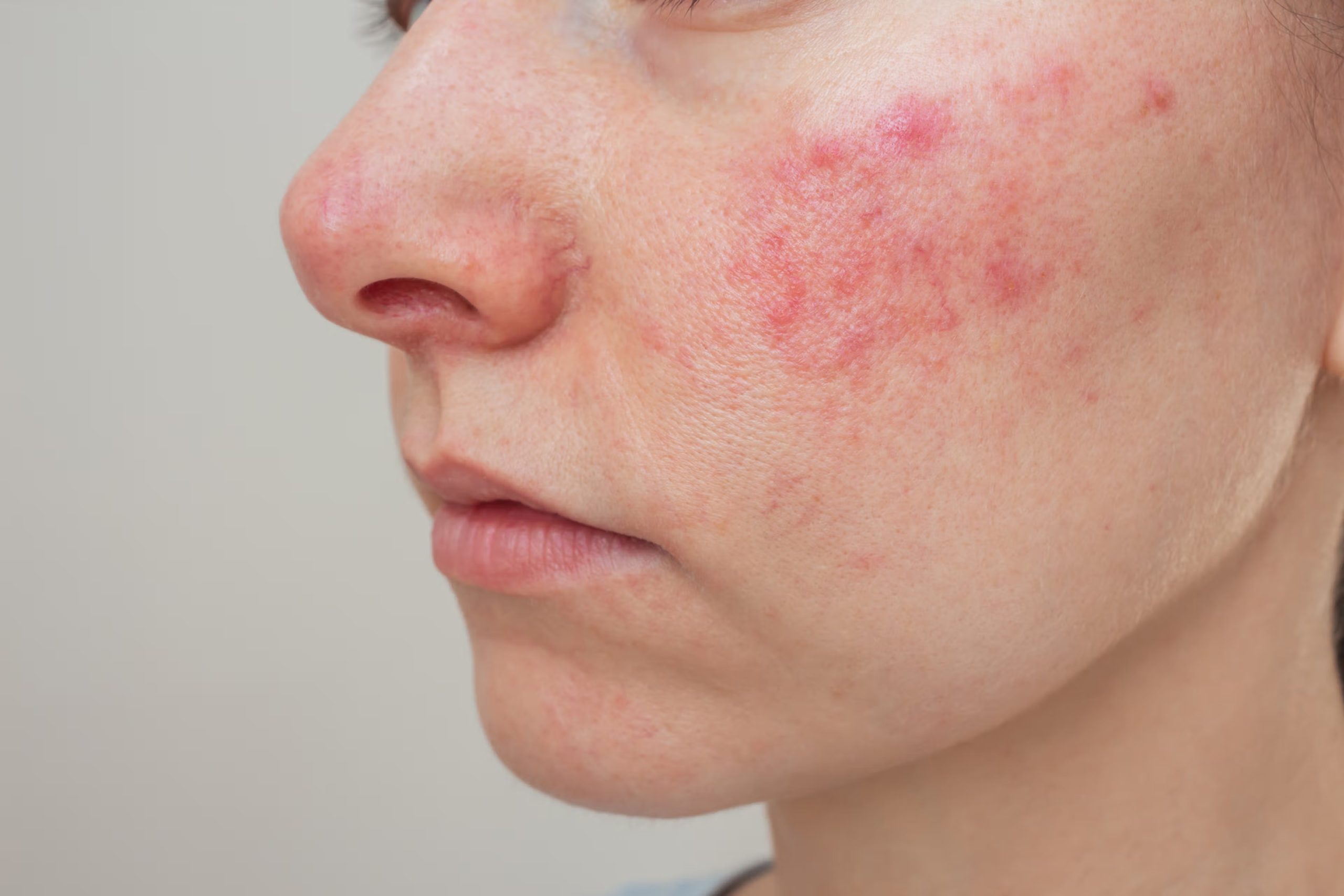 How to Avoid Heat Rash and Other Summer Skin Problems