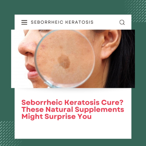 Seborrheic Keratosis Cure