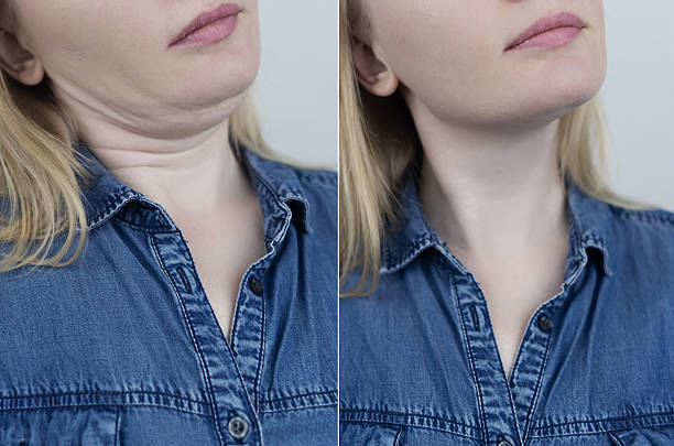 Double Chin Removal in Abu Dhabi