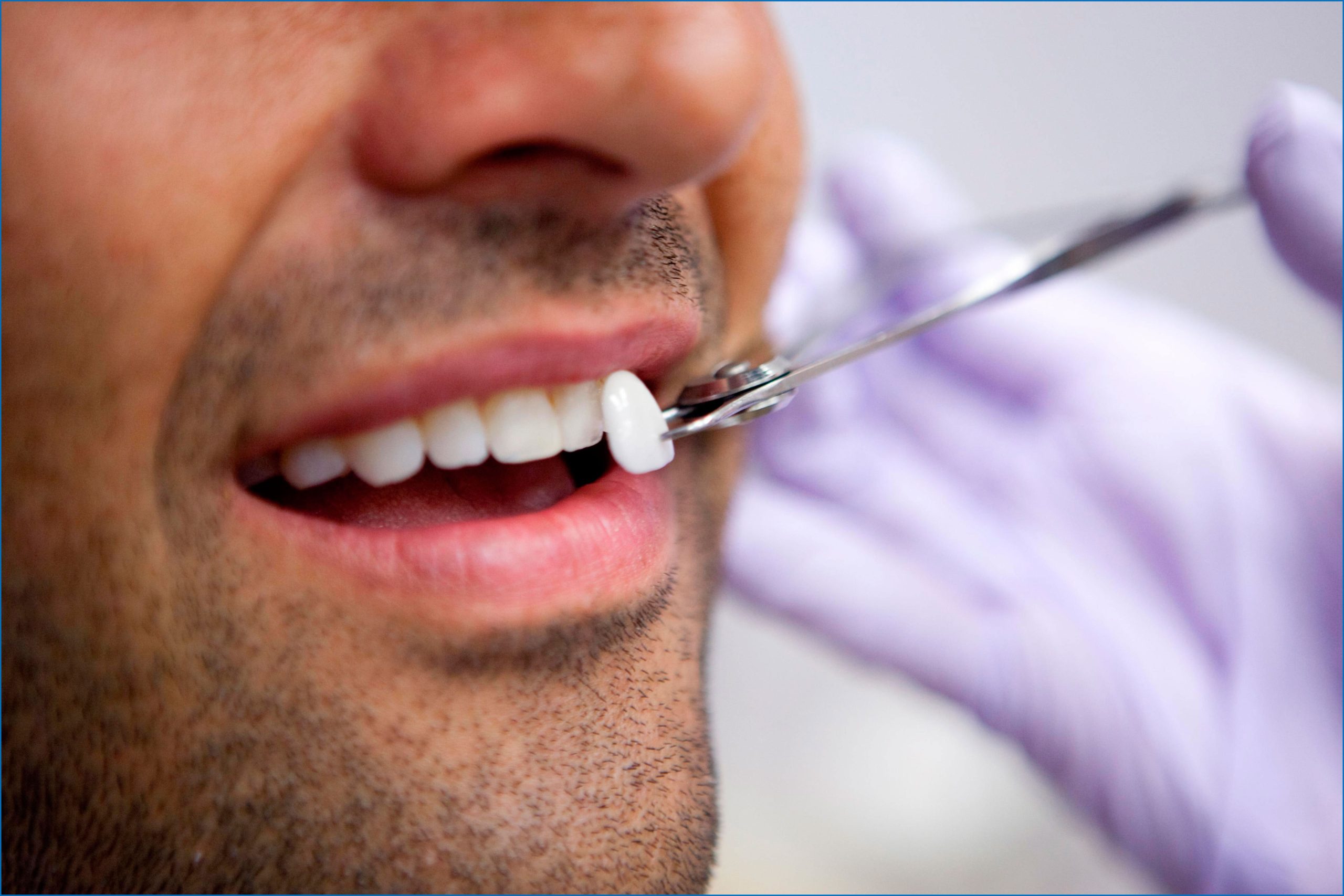 Veneers in Islamabad