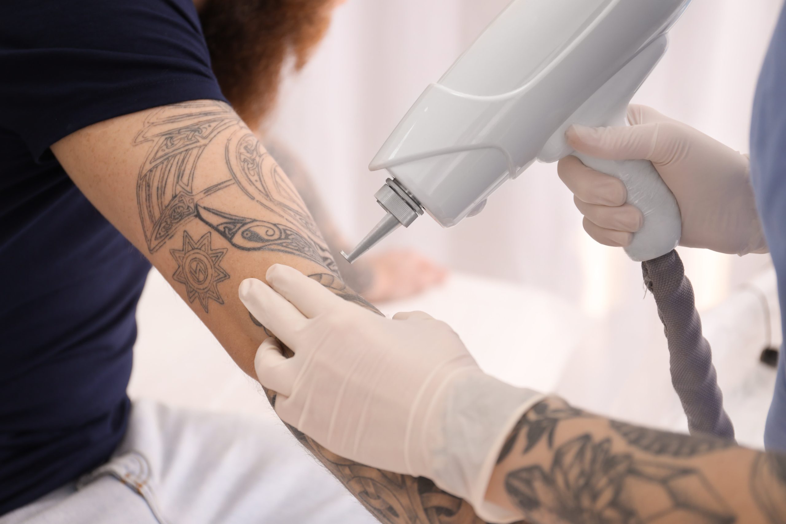 tattoo removal in islamabad